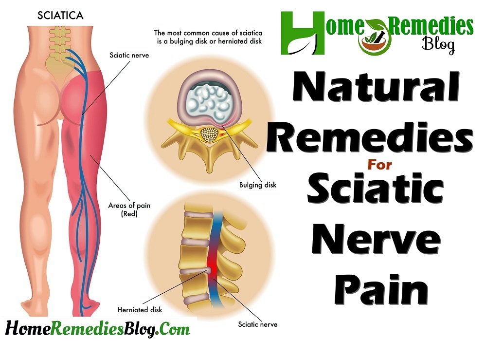 12 Natural Remedies For Sciatica and Nerve Pain