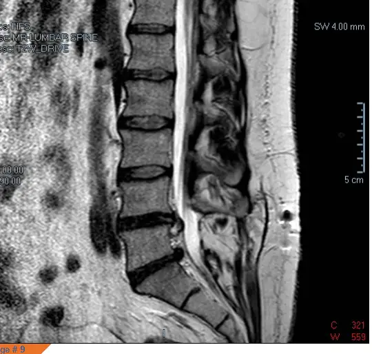 42yo male with severe lower back pain shooting down left leg (4 MRI ...