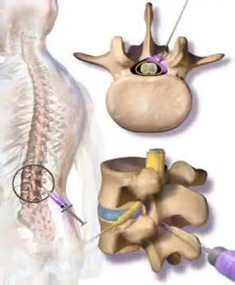 5 Minimally Invasive Pain Management Treatments for Neck and Back Pain ...
