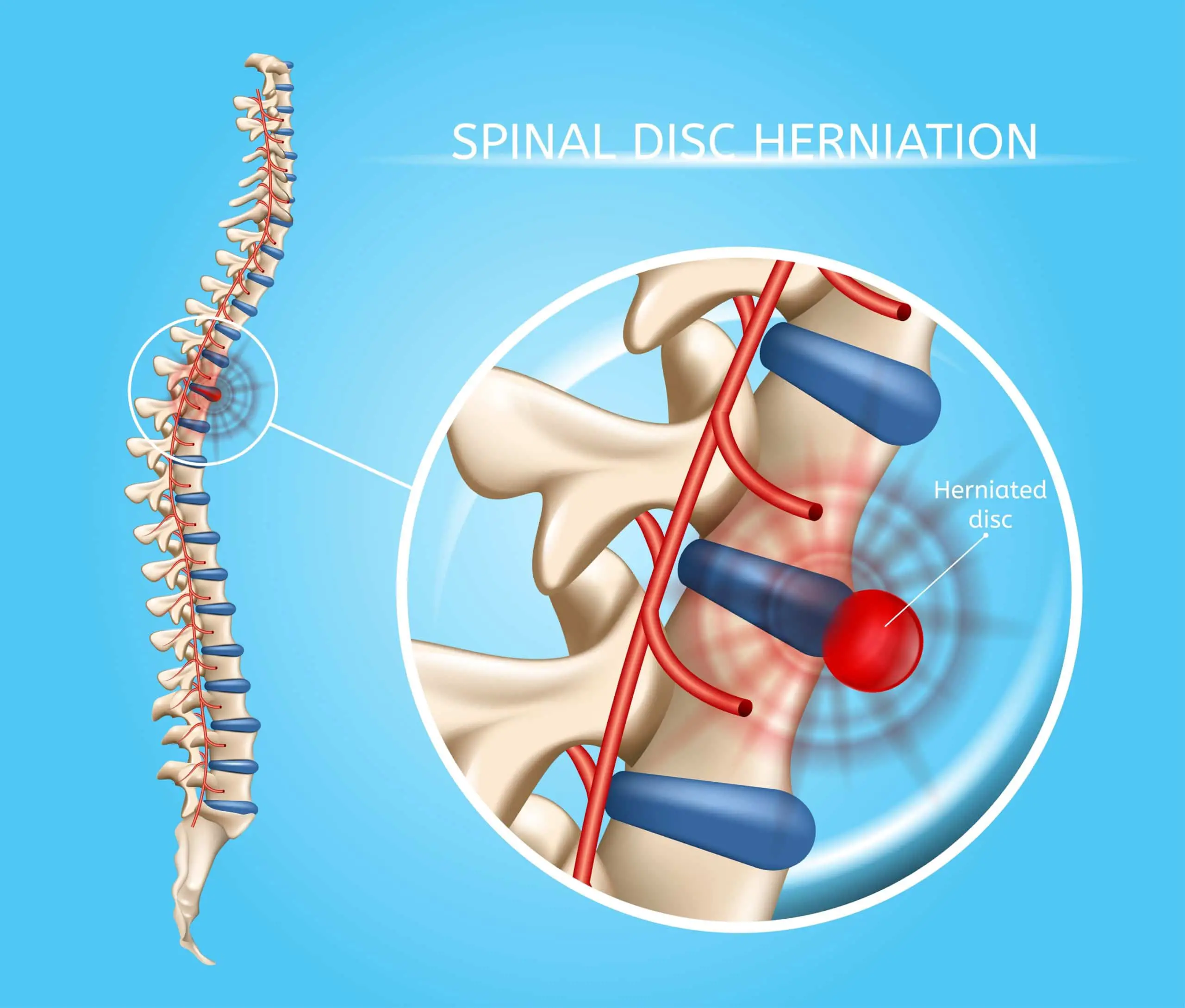 5 Signs of A Herniated Disc &  How A Spine Specialist Can Help