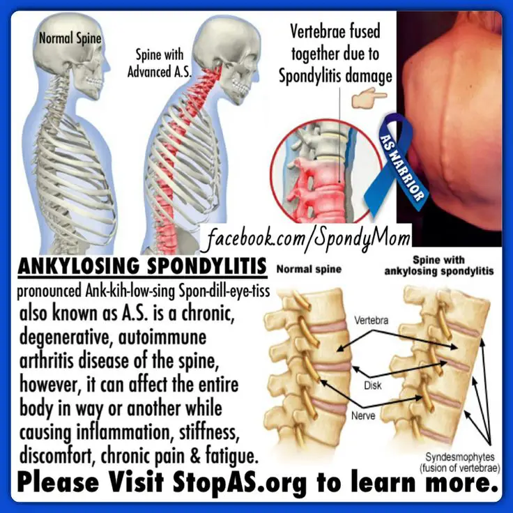 59 best images about Ankylosing Spondylitis on Pinterest