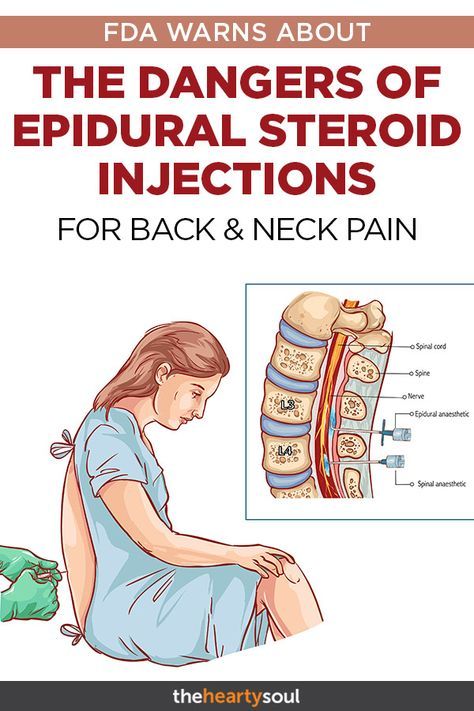 67 Amazing Does Epidural Cause Back Issues