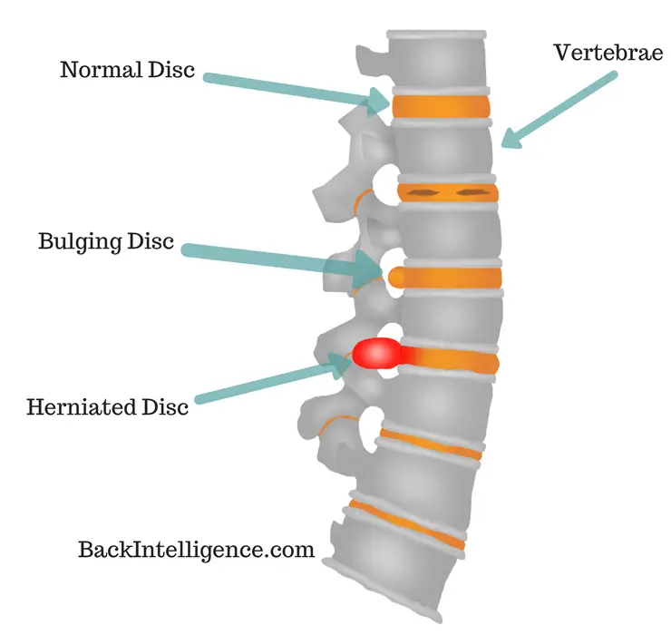 7 Herniated Disc Exercises For Lower Back (Lumbar Area ...