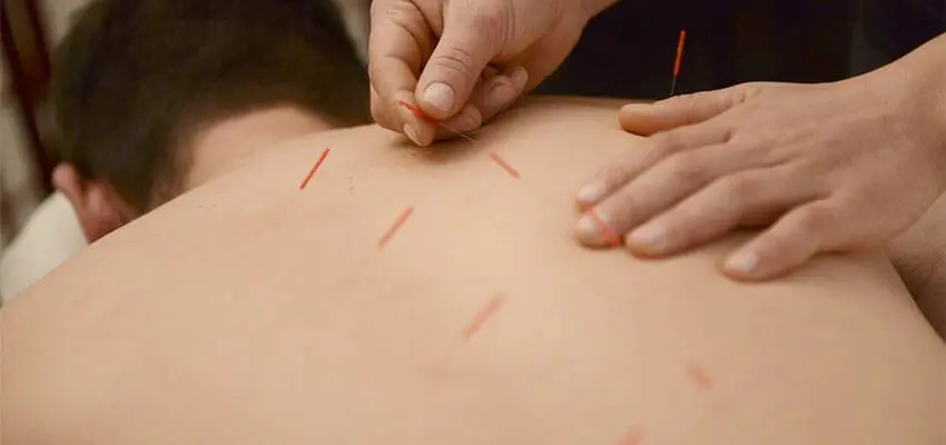 Acupuncture and Your Back Pain: Does it Actually Work ...