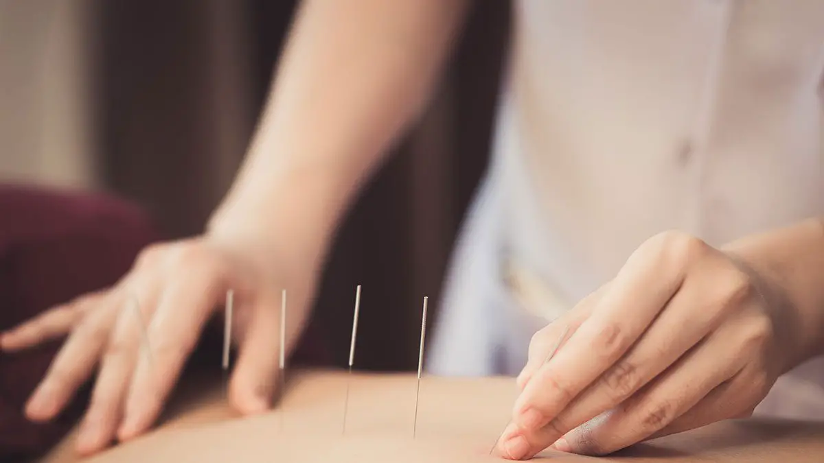 Acupuncture for Back Pain: What to Know About this Pain ...