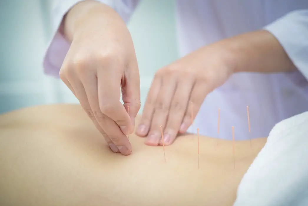 Acupuncture for Lower Back Pain and Sciatica