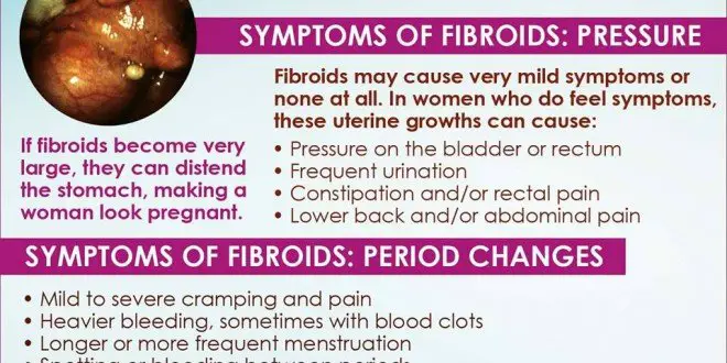 Are there Natural Solution to Get Rid of Uterine Fibroids?