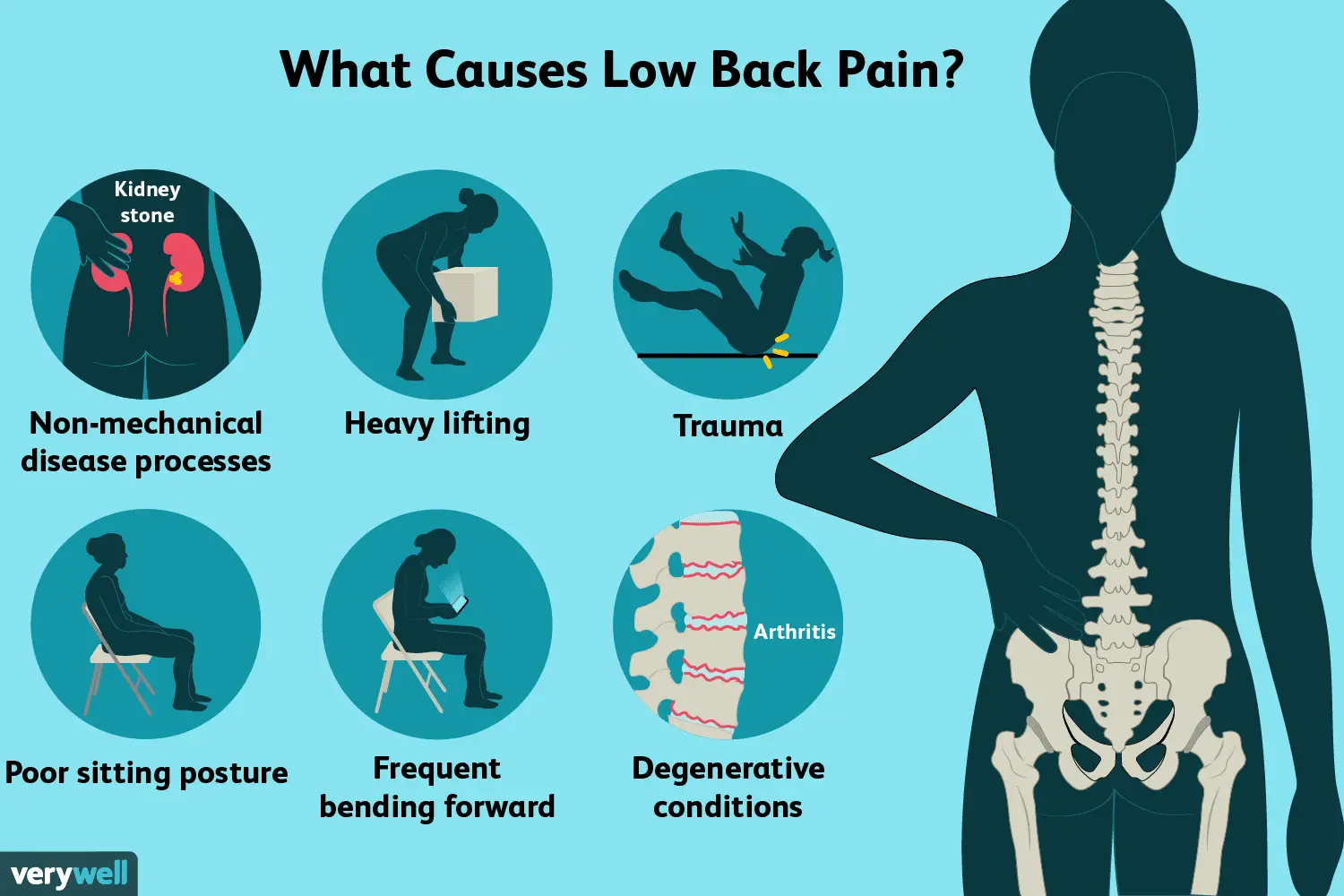 Back Pain: Causes, Treatment, and When to See a Healthcare ...