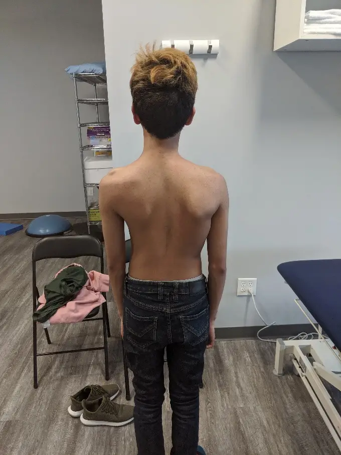 Back Pain: Scoliosis