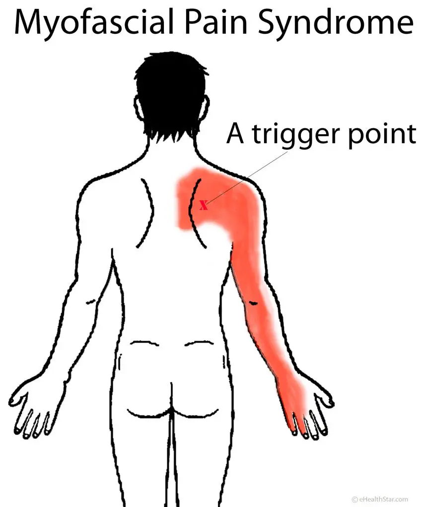 Back Pain: Upper, Middle, Right, Left, Sudden, Severe, Chronic ...