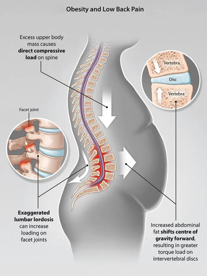 Belly Fat Can Cause Back Pain and Injury