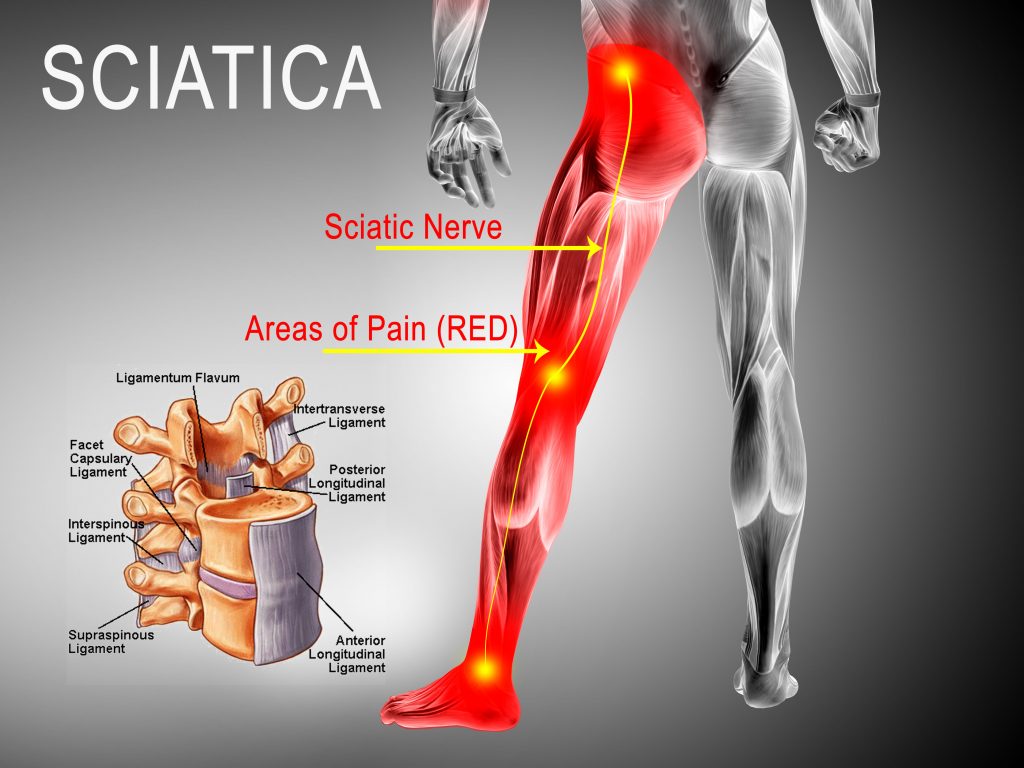Best Ways to Treat Sciatica Pain