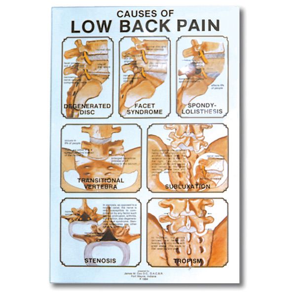 Buy Causes Of Low Back Pain Poster 24"  X 36"  Laminate
