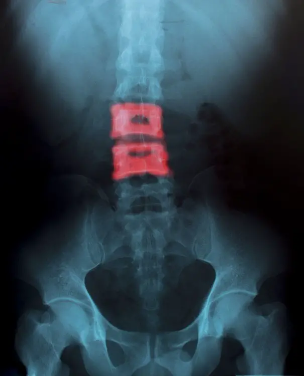 Can a Herniated Disc in the Low Back Cause Neck Pain?