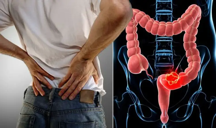 Can Back Pain Be A Sign Of Colon Cancer