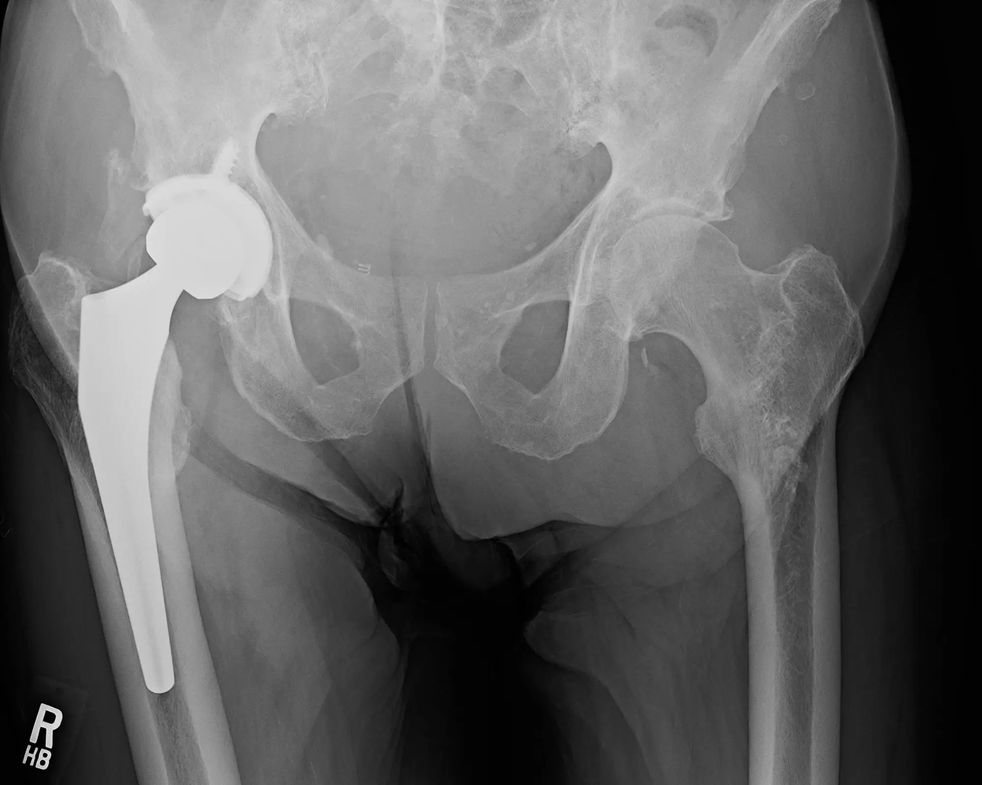 Case Study: Chronic Pain and Stiffness After Total Hip ...