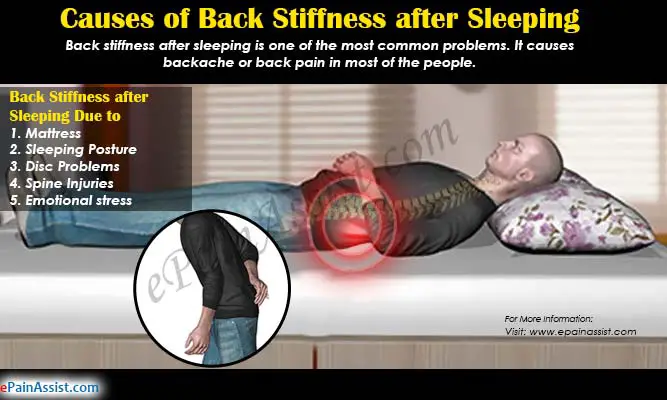 Causes of Back Stiffness after Sleeping &  its Treatment, Exercises