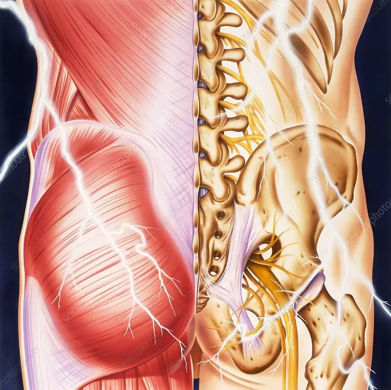 Causes of backache and pain, illustration