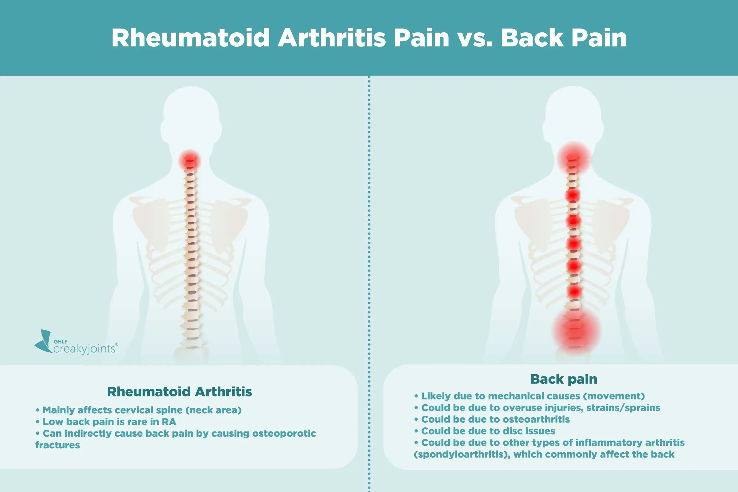 Causes of Rheumatoid Arthritis Pain Aside from Inflammation