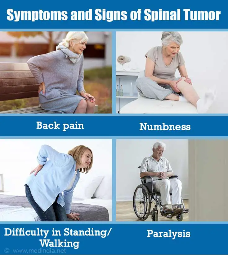 Causes, Symptoms and Signs of Spinal Tumors