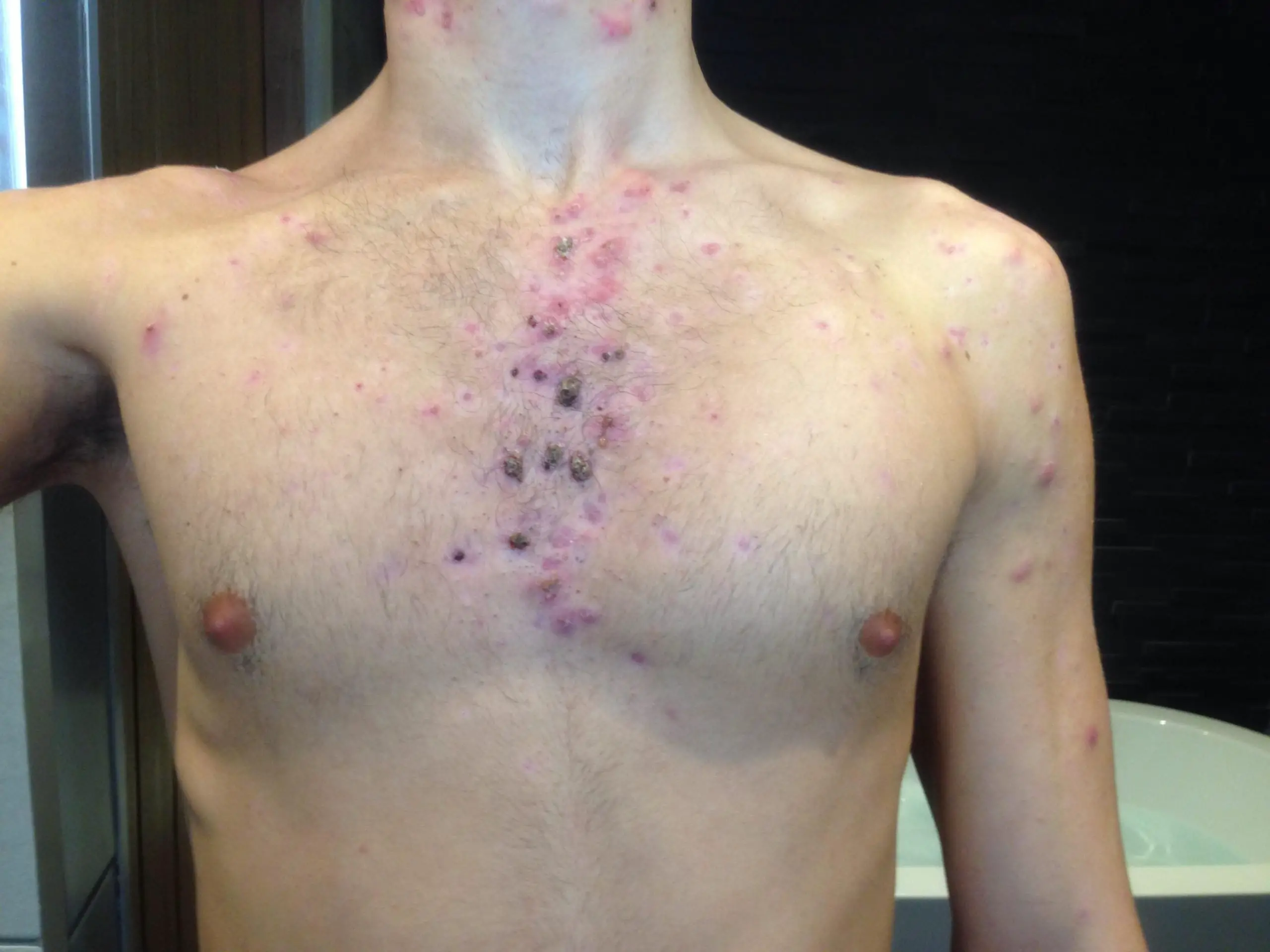 Chest, Neck And back cystic acne