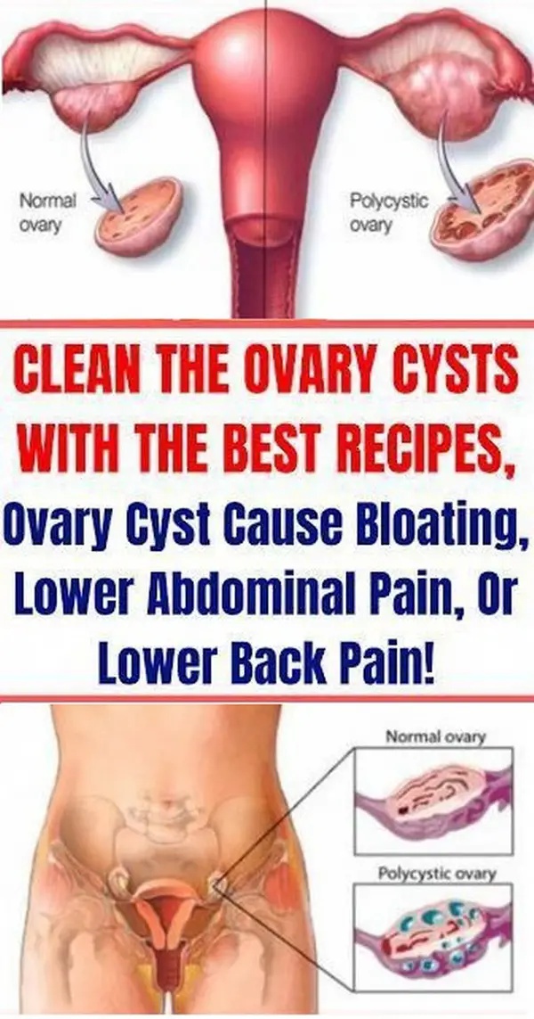 Clean The Ovary Cysts With The Best Recipes, Ovary Cyst ...