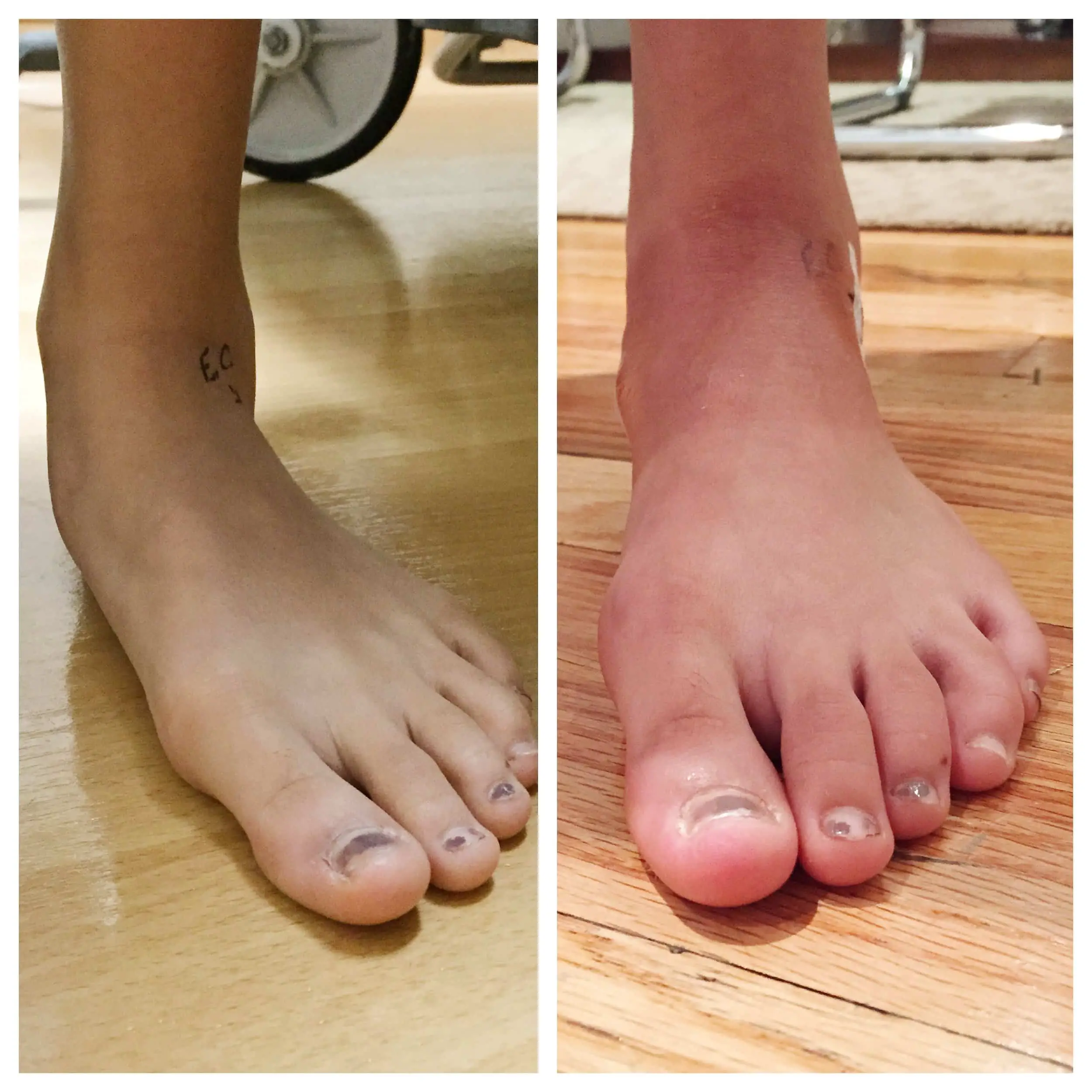 Correcting a Flexible Pediatric Flat Foot to Avoid Adult Bunions ...