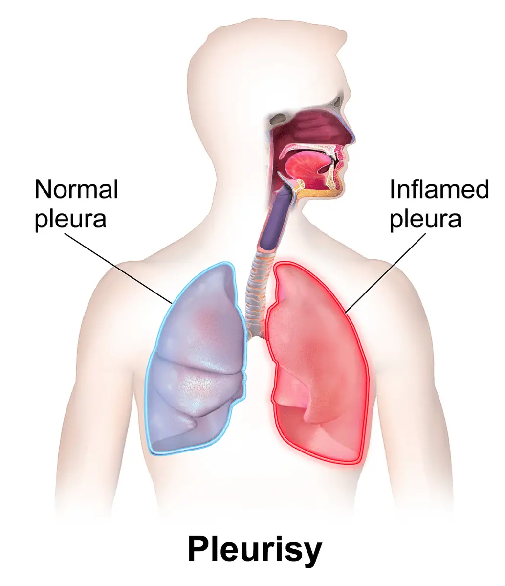 Difference Between Bronchitis and Pleurisy