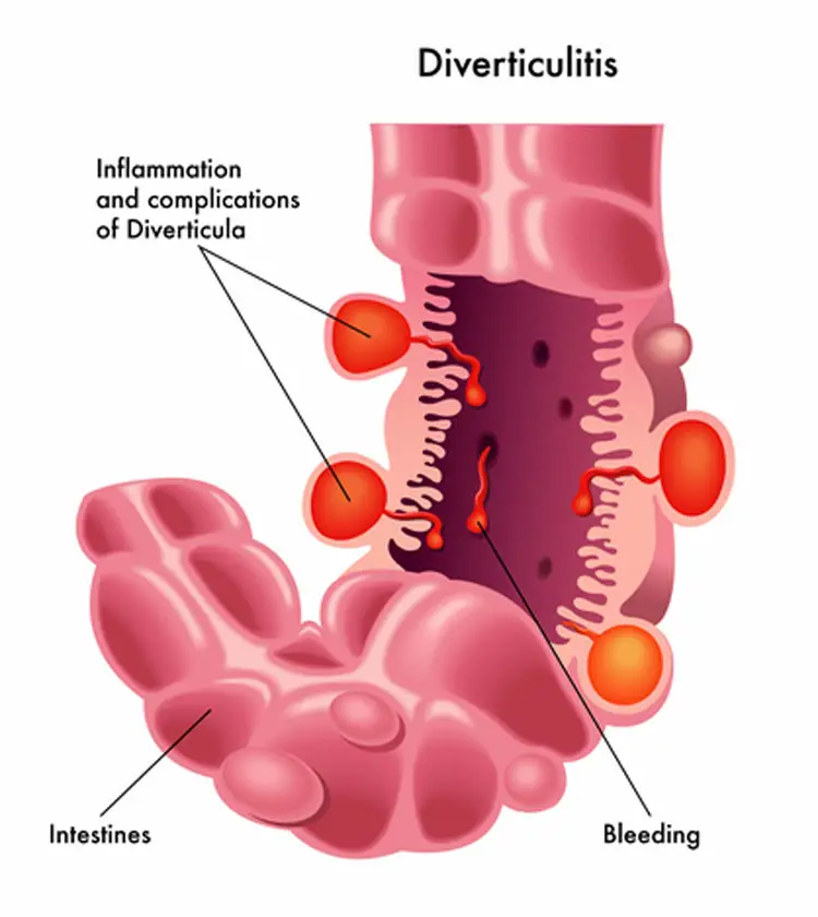 Diverticulitis and Low Back Pain: 5 Common Complications