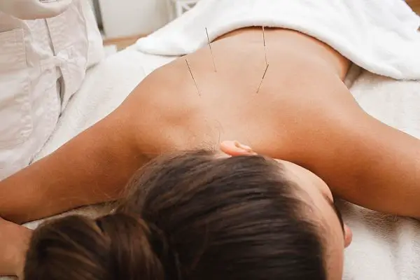 Does Acupuncture Work For Back Pain?