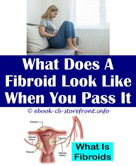 Épinglé sur Fibroid Outside Uterus