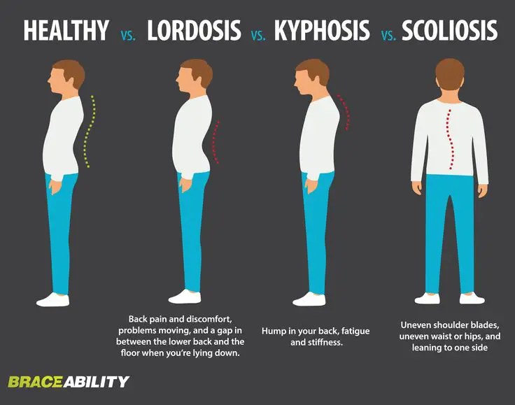 Find out what spinal curvature disorder you have: lordosis ...
