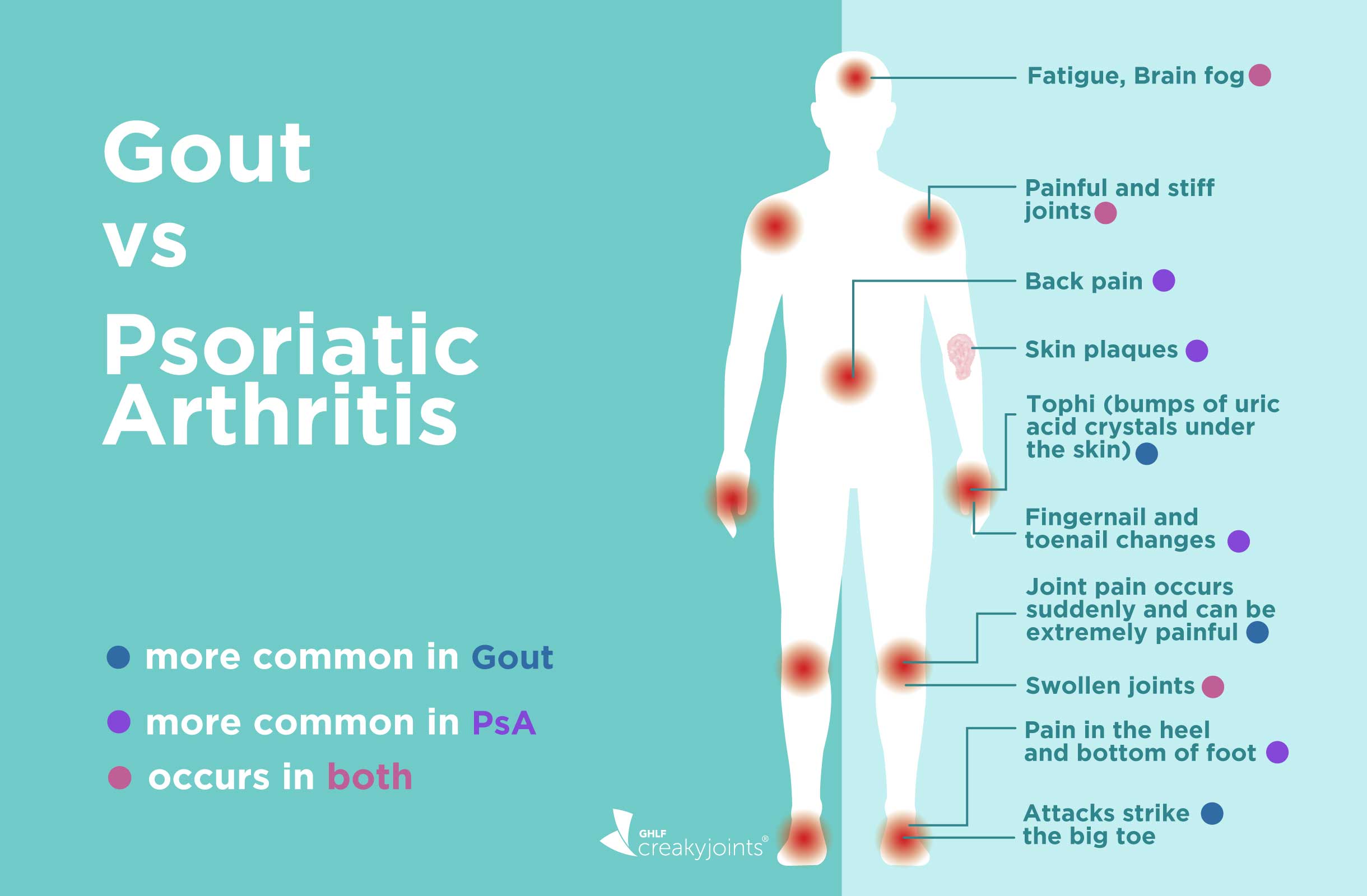 Gout vs. Psoriatic Arthritis: Differences in Symptoms and ...
