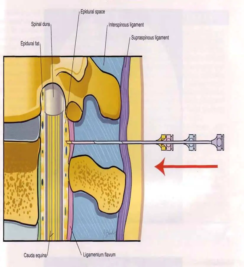 HEALTH FROM TRUSTED SOURCES: Epidural steroid injections for spinal pain