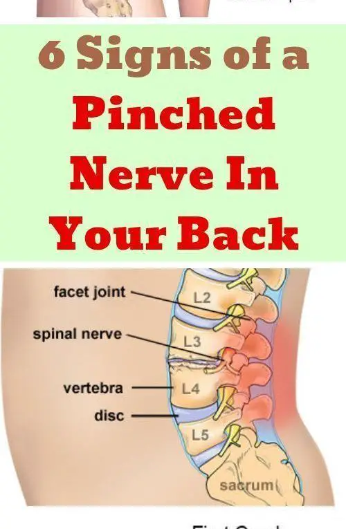 Here Are 6 Signs Of A Pinched Nerve In Your Back