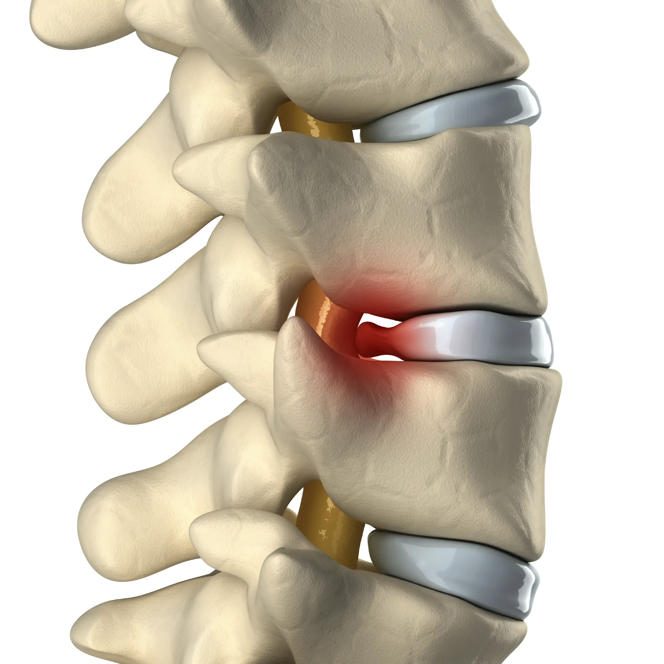 Herniated Disc / Bulging Disc / Protruding Disc  Michigan Spine &  Pain