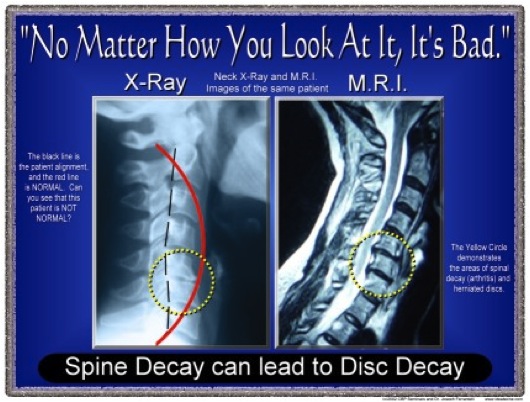 Herniated Disc Chiropractor in St. Paul