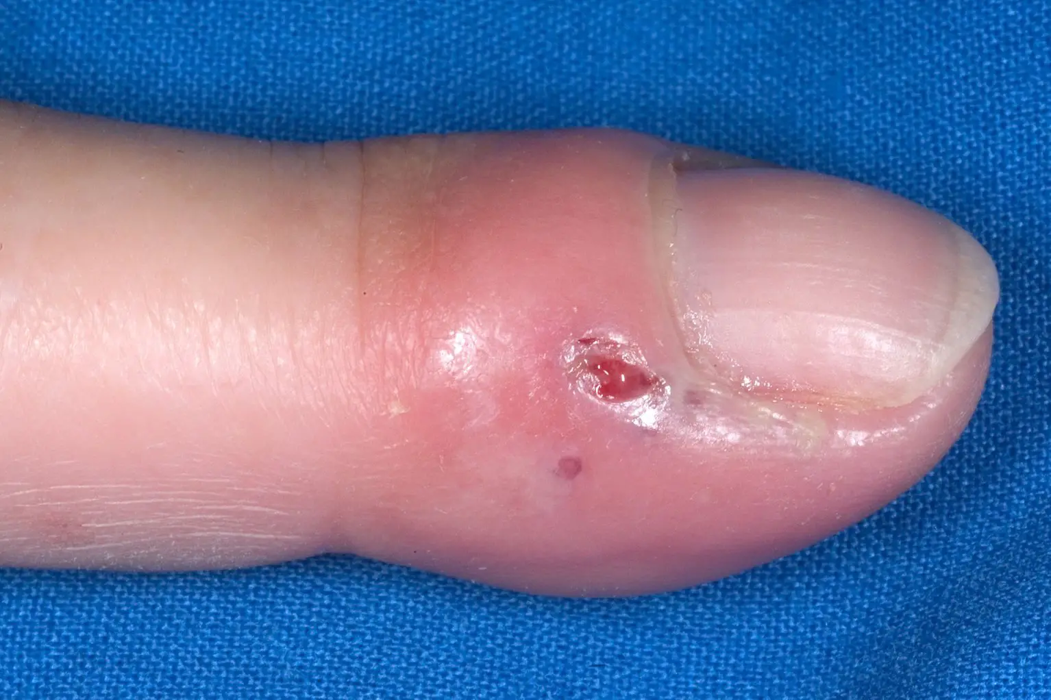 Herpetic whitlow (whitlow finger)