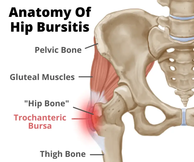 Hip Bursitis: Why Low Back Dysfunction is the Missing Piece of the ...