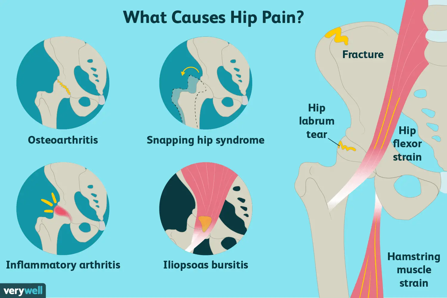 Hip Pain: Causes, Treatment, and When to See a Healthcare ...