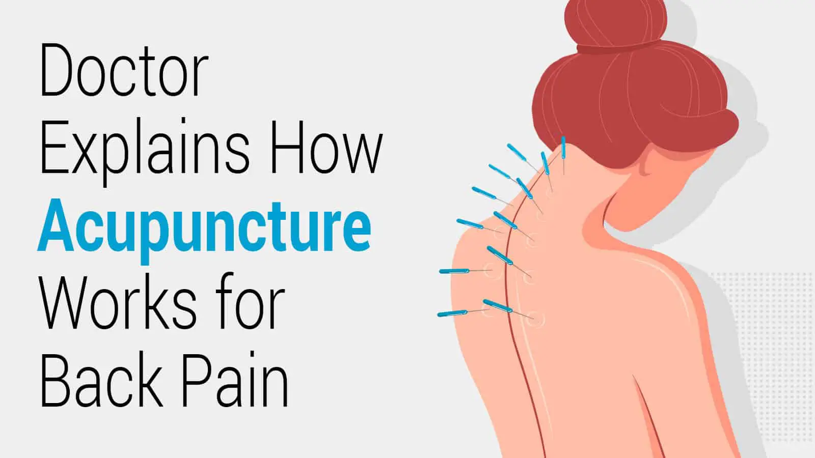 How Acupuncture Actually Works for Back Pain? A Doctor ...