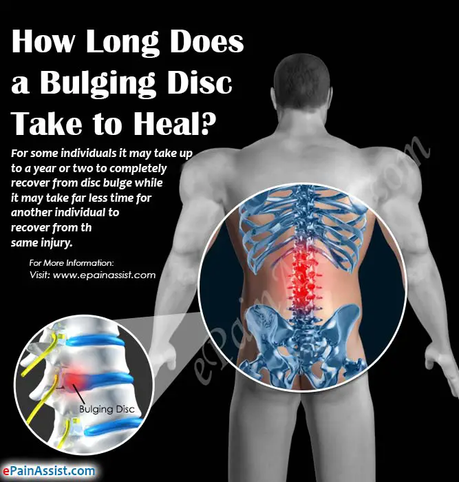 How Long Does a Bulging Disc Take to Heal?