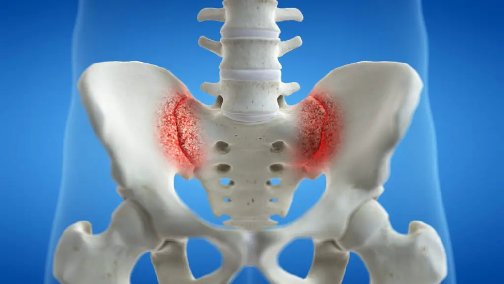 How Long Does It Take Sacroiliac Joint Pain to Go Away?
