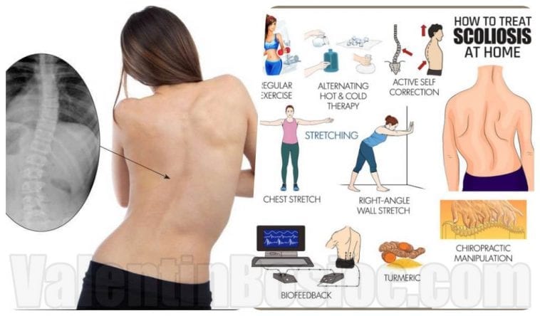 How to Deal with Scoliosis At Home TREATMENT