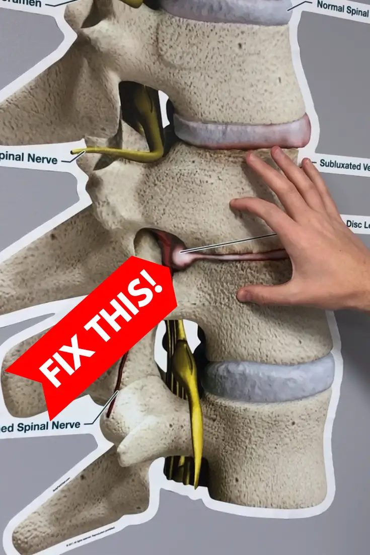How to Fix a Bulging Disc in Your Lower Back