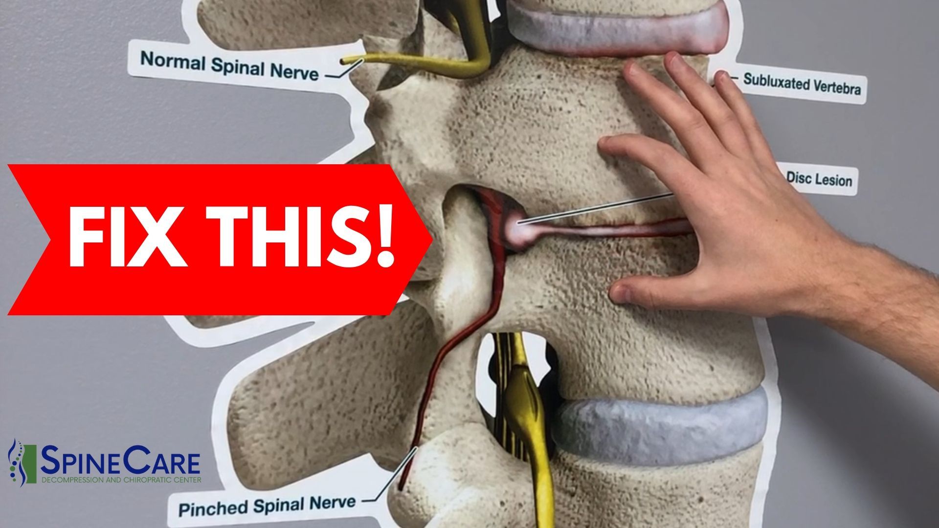 How to Fix a Bulging Disc in Your Lower Back