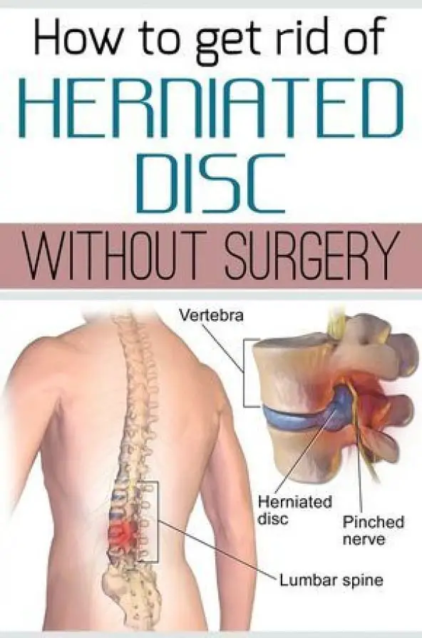 How to get rid of herniated disc without surgery ...