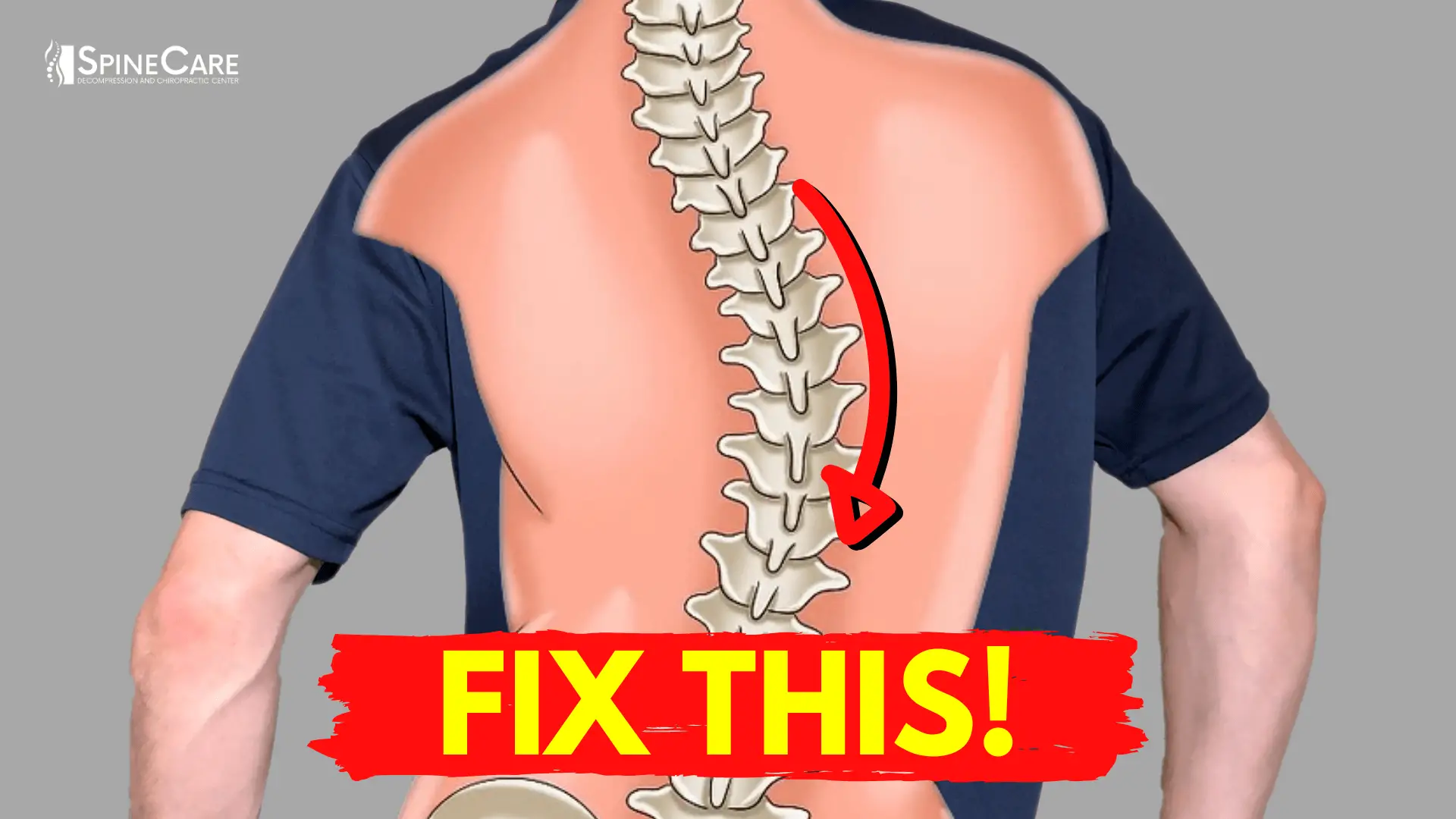 How to Relieve Your Scoliosis Back Pain in 30 SECONDS ...