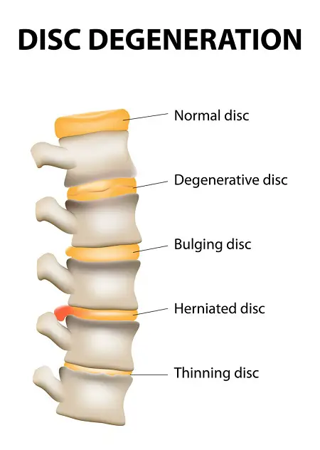 How To Fix Degenerative Disc In Lower Back
