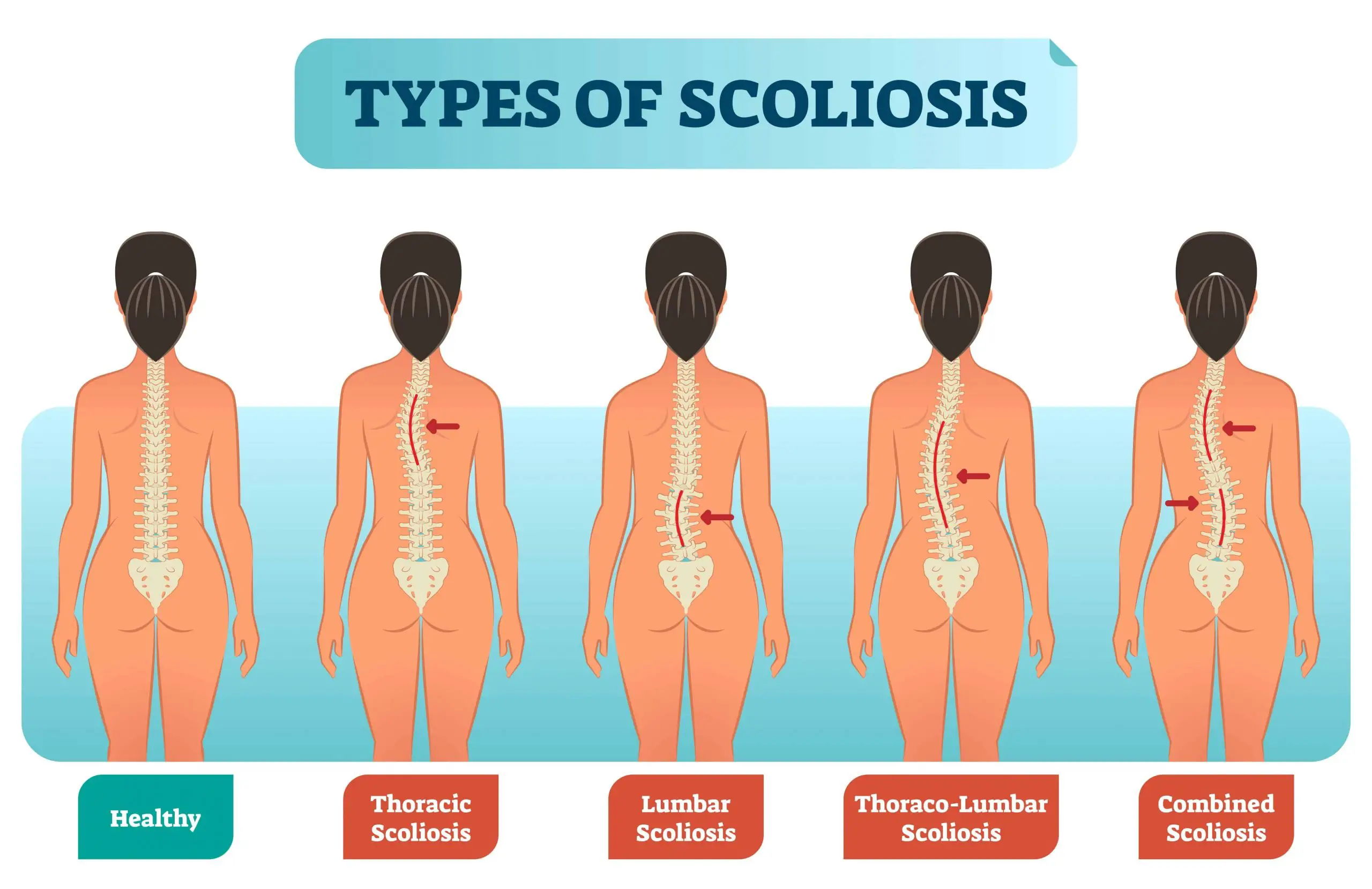 How to Sleep With Scoliosis (Helpful Tips Included)